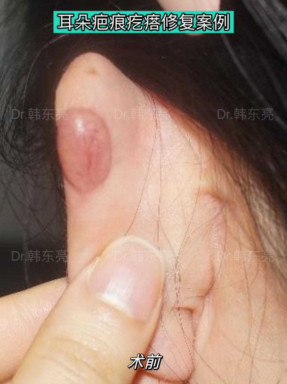 【耳朵疤痕疙瘩修复案例】 及早对耳部疤痕疙瘩采取手术切除的综合