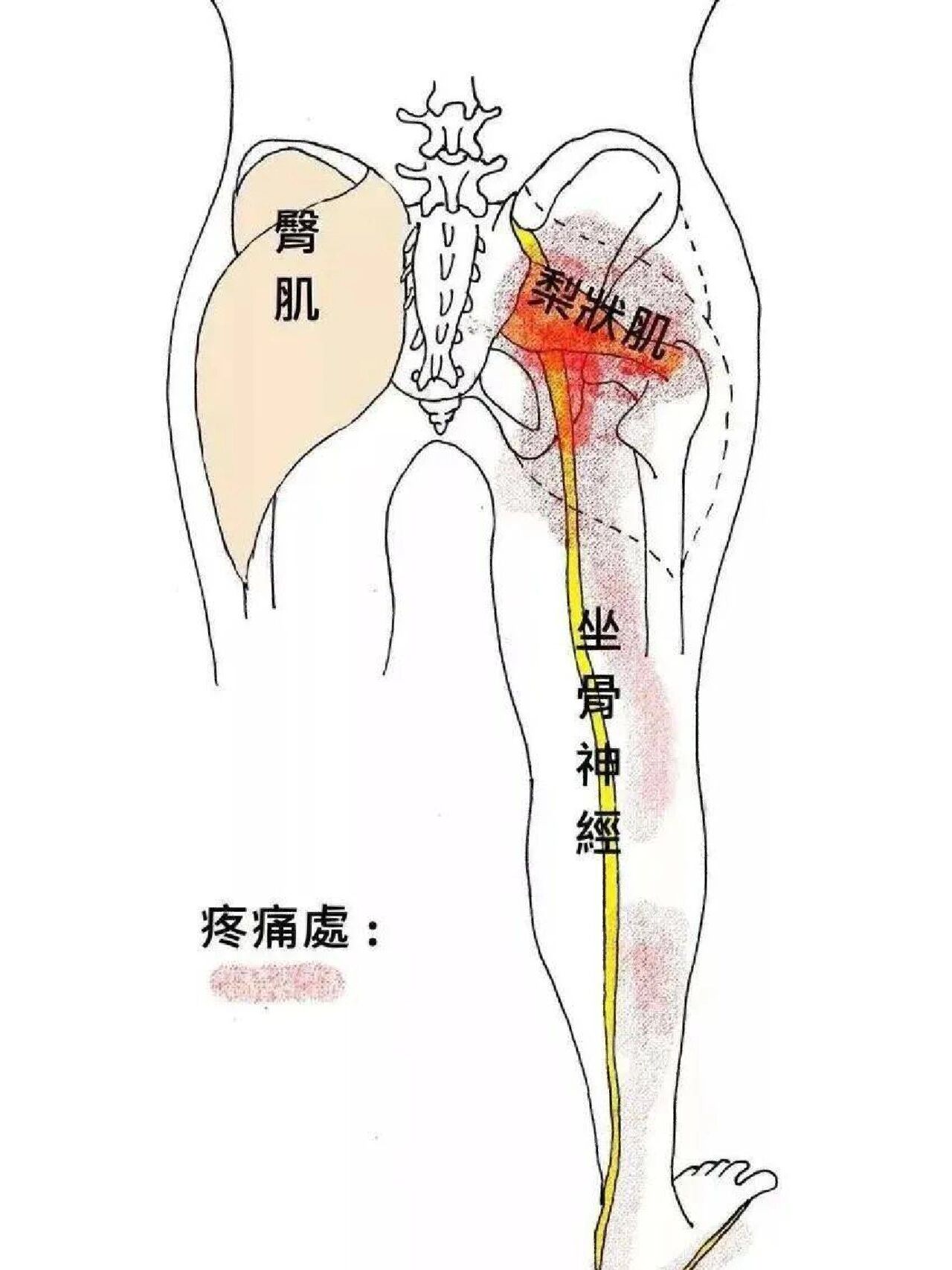 针灸治疗——坐骨神经痛 94疼痛点-腰,臀,大腿后侧,小腿后外侧,足