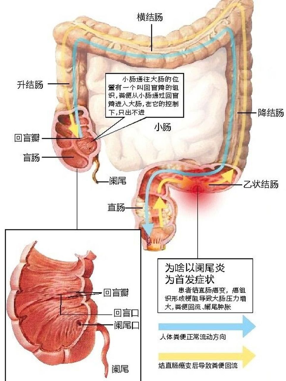 阑尾在哪个位置?女性图片