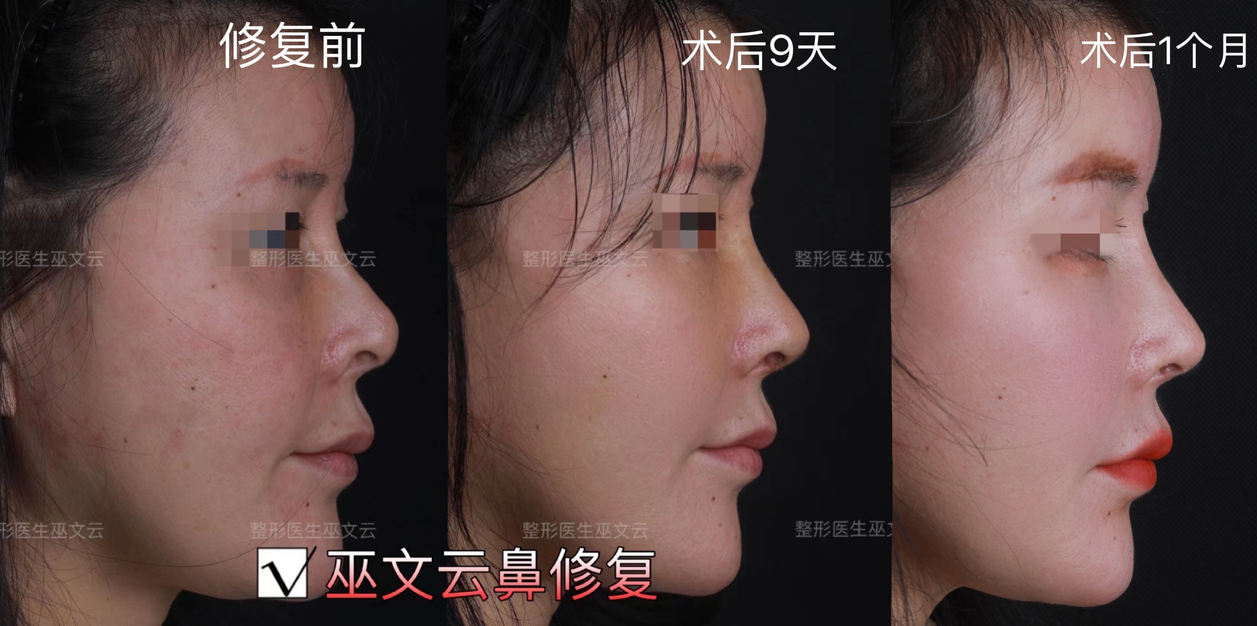 东方人好看的女性鼻子的,鼻唇角在100度-105之间,过分抬高鼻尖鼻小柱