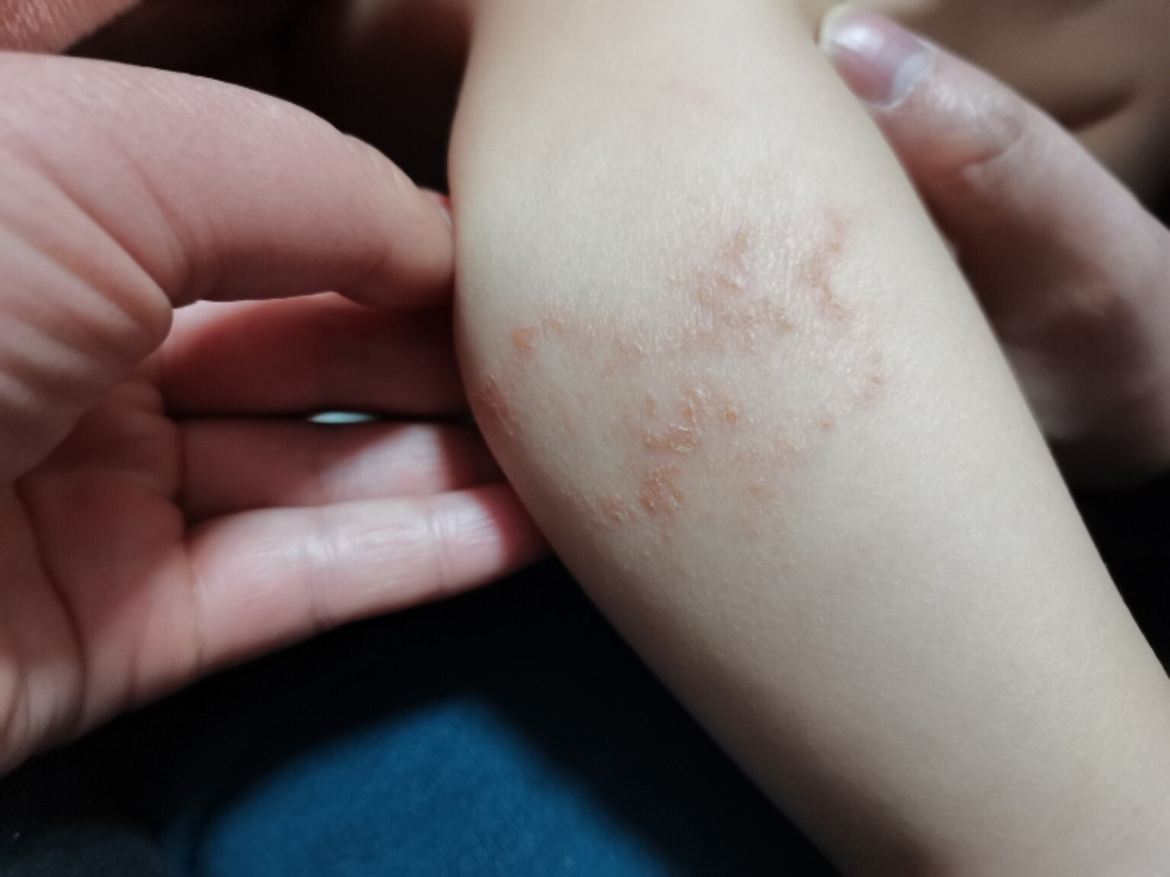 各位宝妈们我家宝宝腿上起的是不是癣?