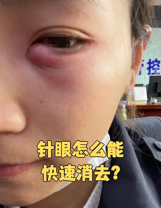 麦粒肿一般第几天最严重为什么在线
