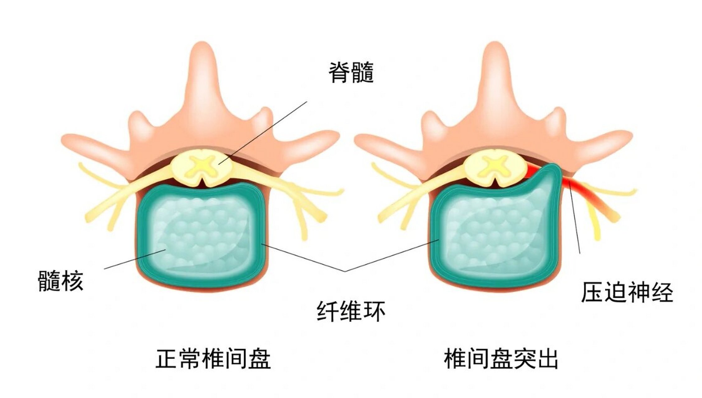【腰椎间盘突出症 吃什么药?