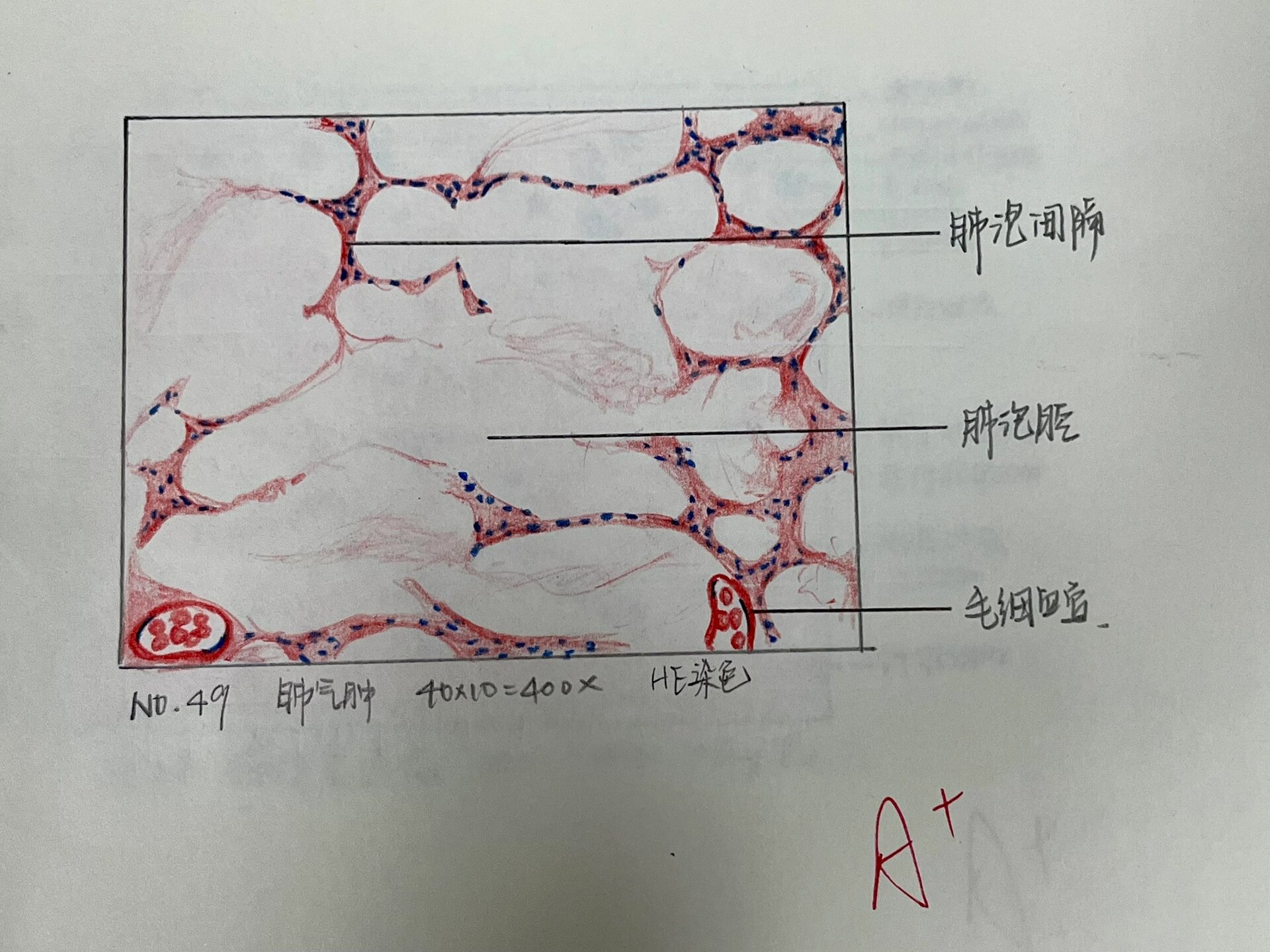 胃溃疡手绘图红蓝铅笔图片