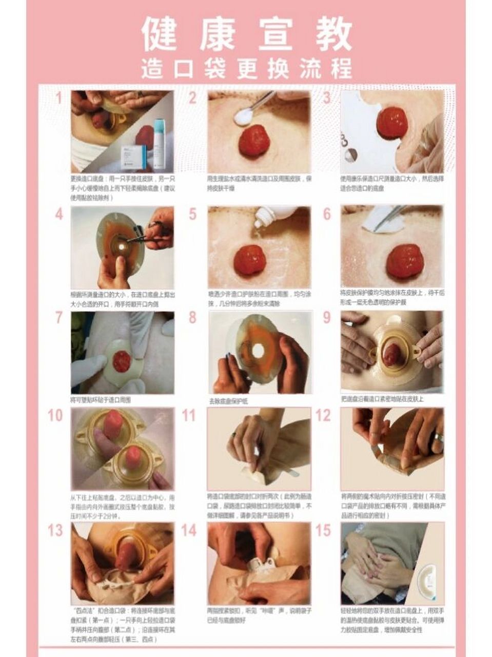 造口袋更换流程 造口