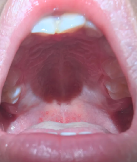 这种病主要由肠道病毒感染引起,典型表现包括突然发热,持续高热或反复