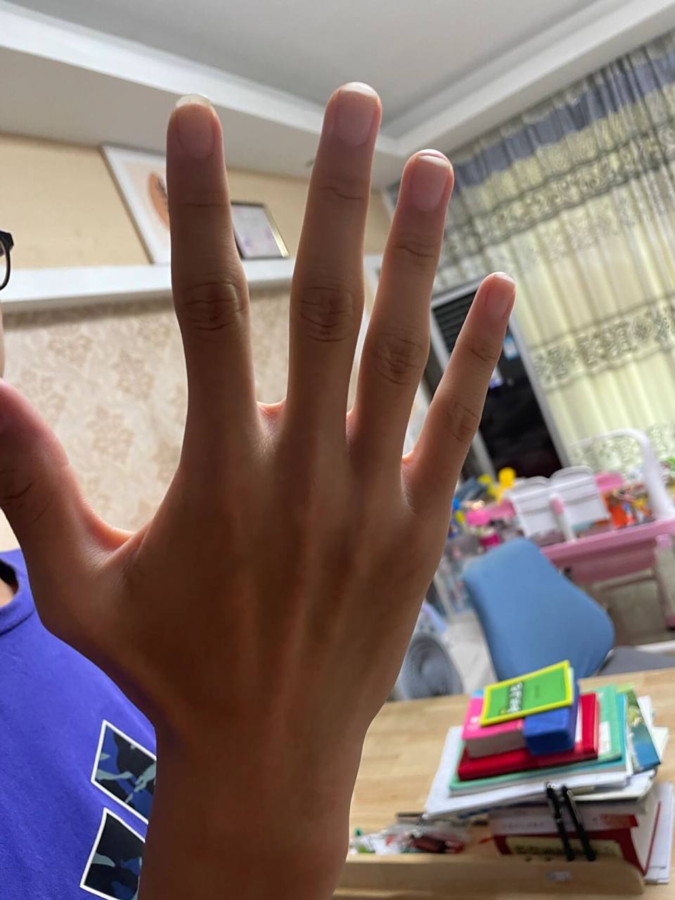 这能看出是马凡综合症吗?