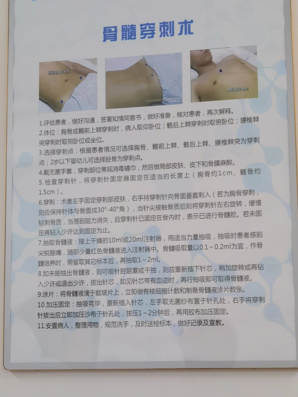 骨穿定位示意图图片