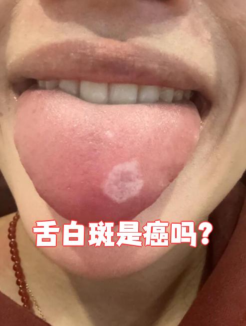 舌白斑本身不是癌症,但如果不及时处理,可能会发展成口腔癌