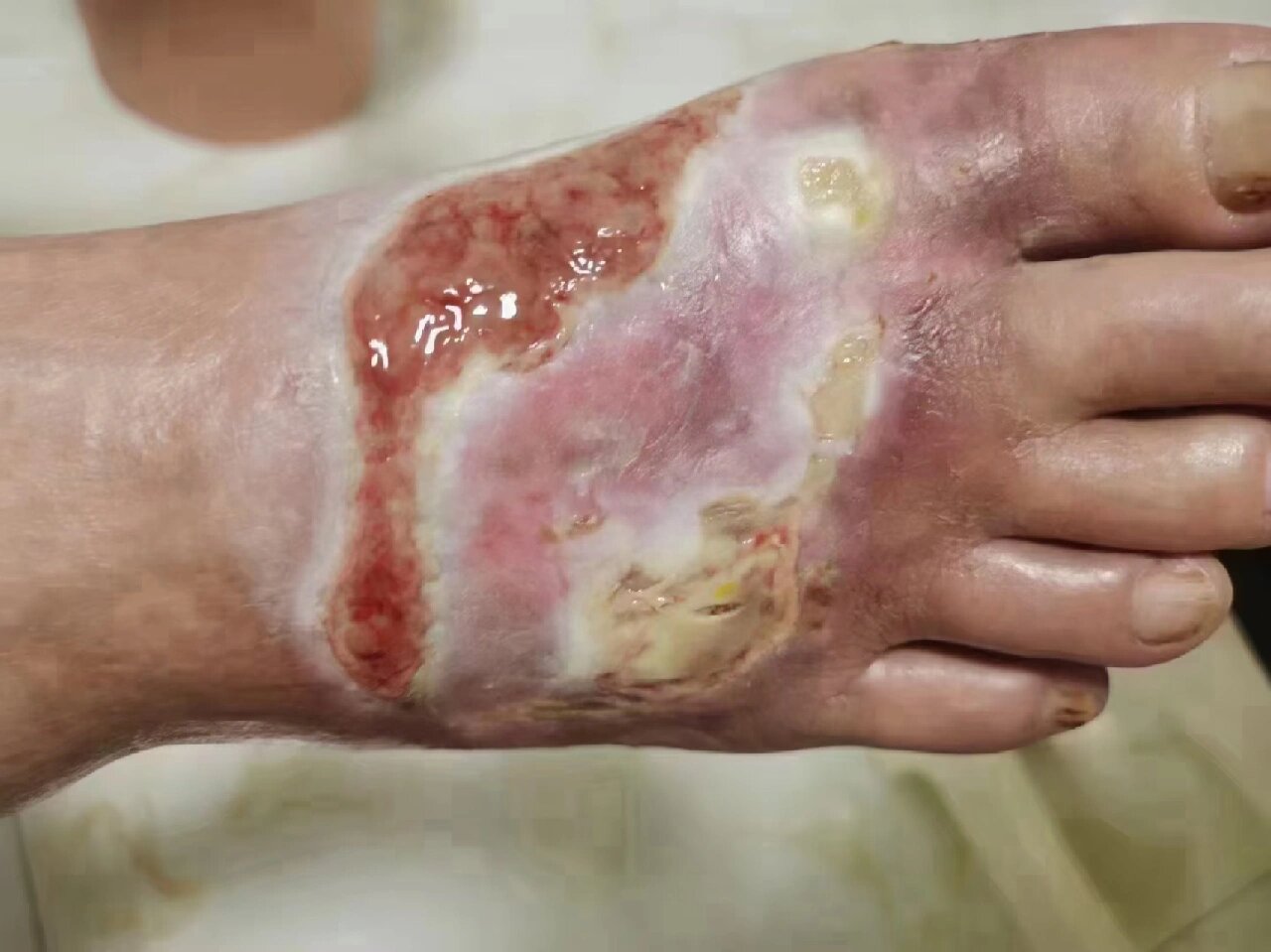 时间久的疤痕一直不愈合,称之为经久不愈的伤口,用上古方药油加生肌膏