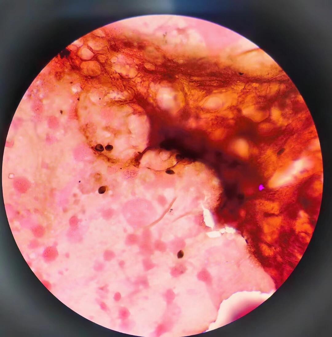 卡氏肺孢子虫(六胺银染色) 卡氏肺孢子虫(pneucystis carinii delanoe