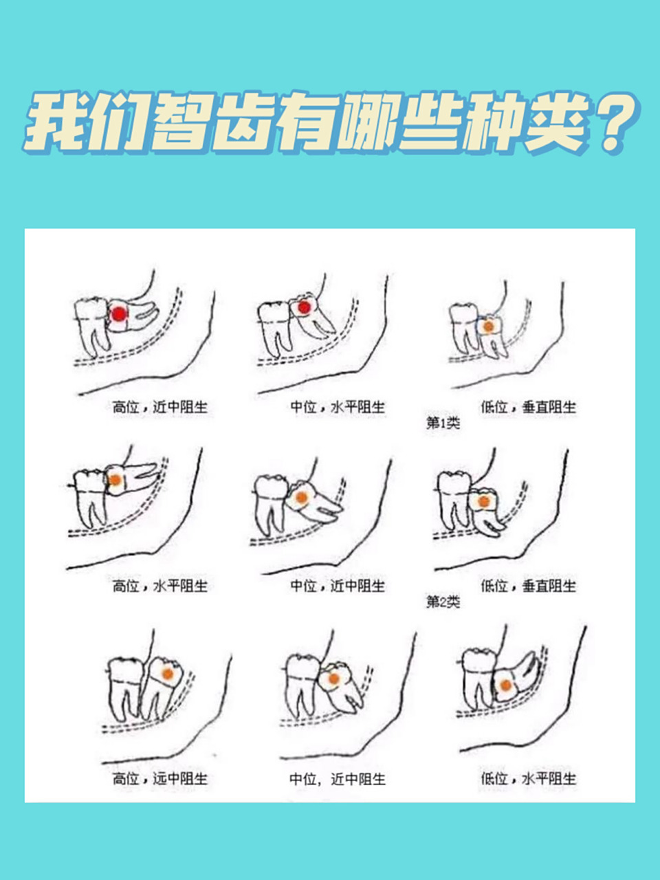 给大家做了关于智齿的功课,希望大家少走点弯路~ 我们智齿的类型有
