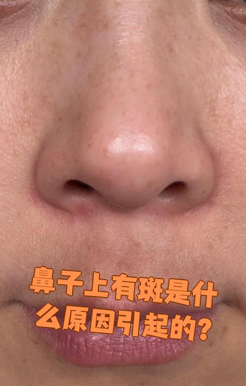 为什么鼻子上的斑越来越重百科在线 为什么鼻子上的斑越来越重百科在线