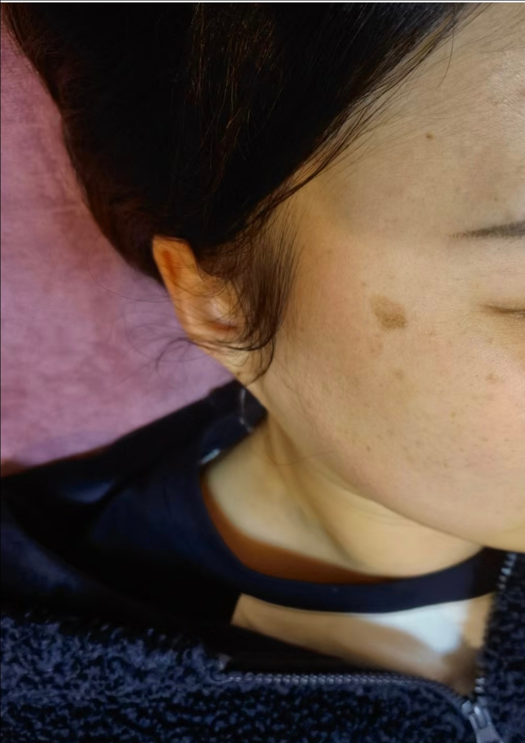 首先是紫外线刺激,特别是长波紫外线