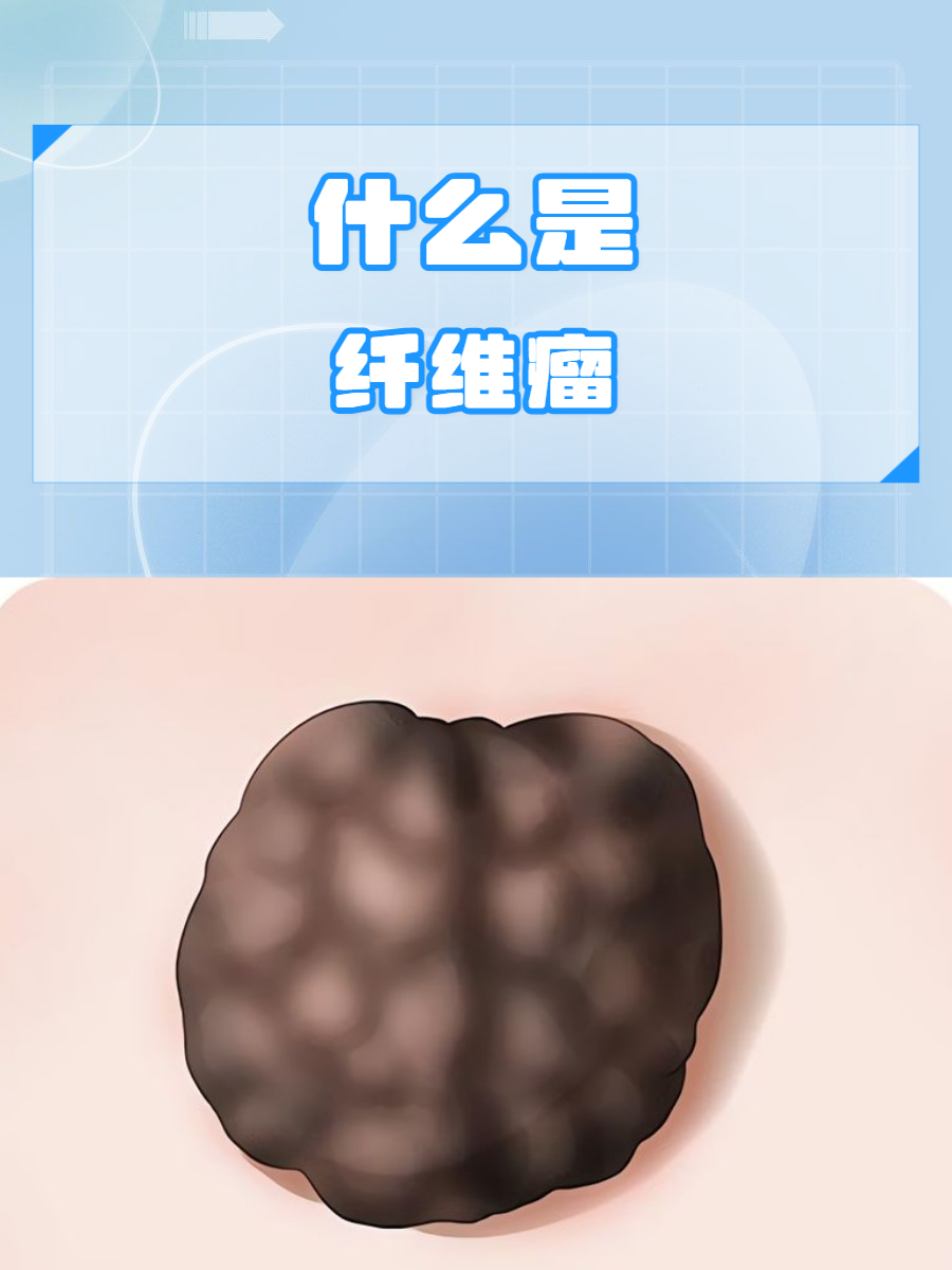 这个小疙瘩,很可能是纤维瘤