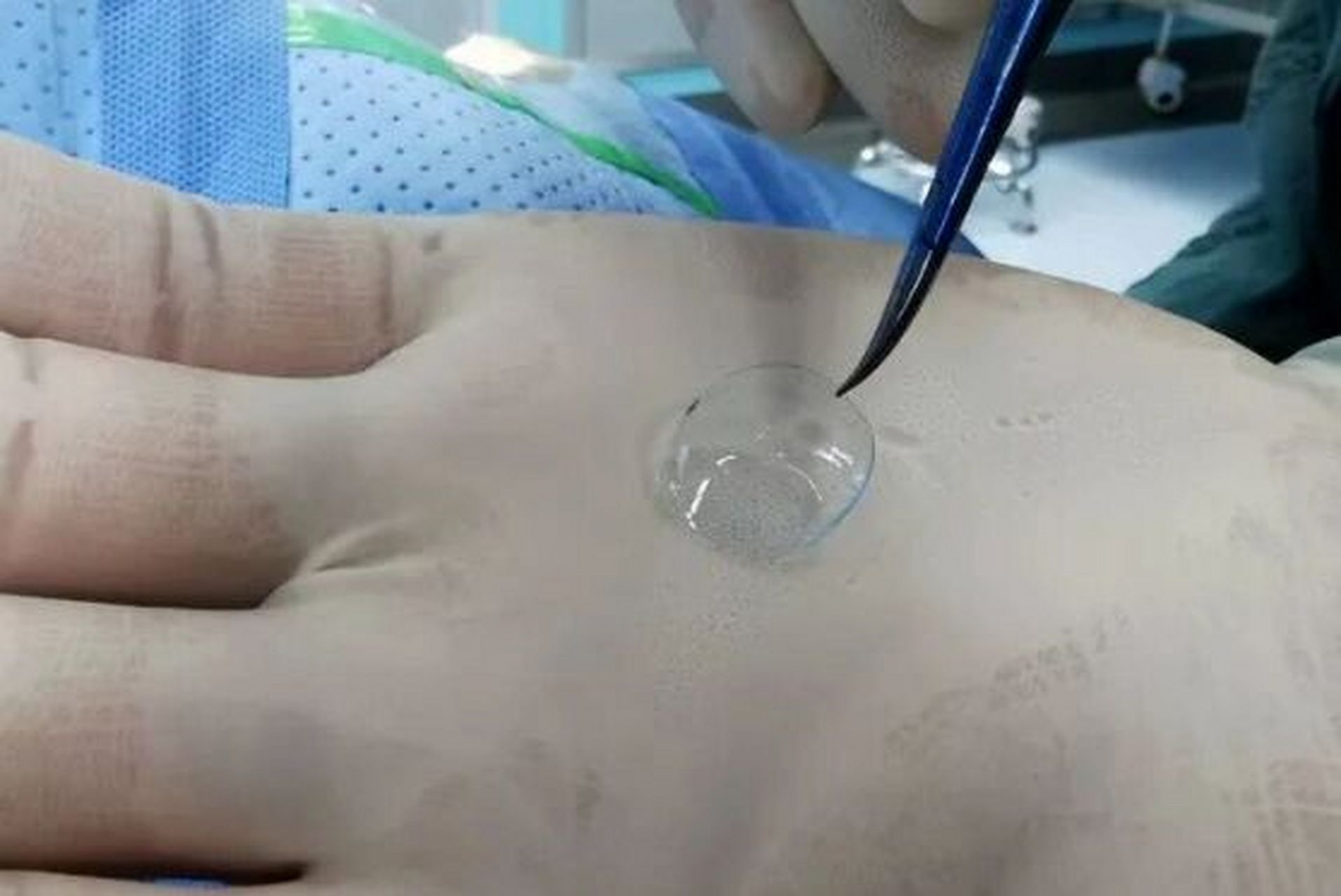 在眼表疾病的防治中,角膜绷带镜应用很是广泛.