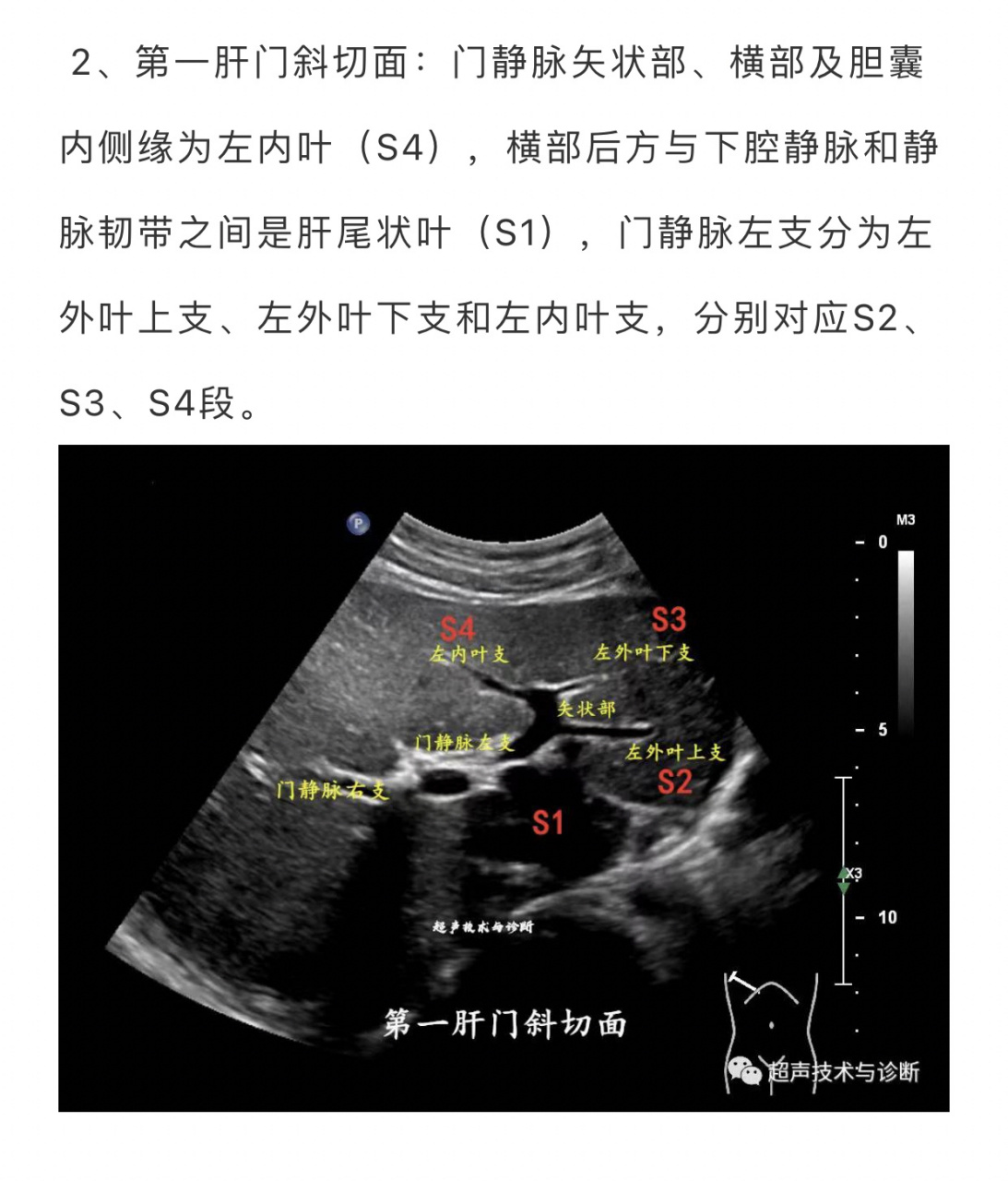 第一肝门横断面图片