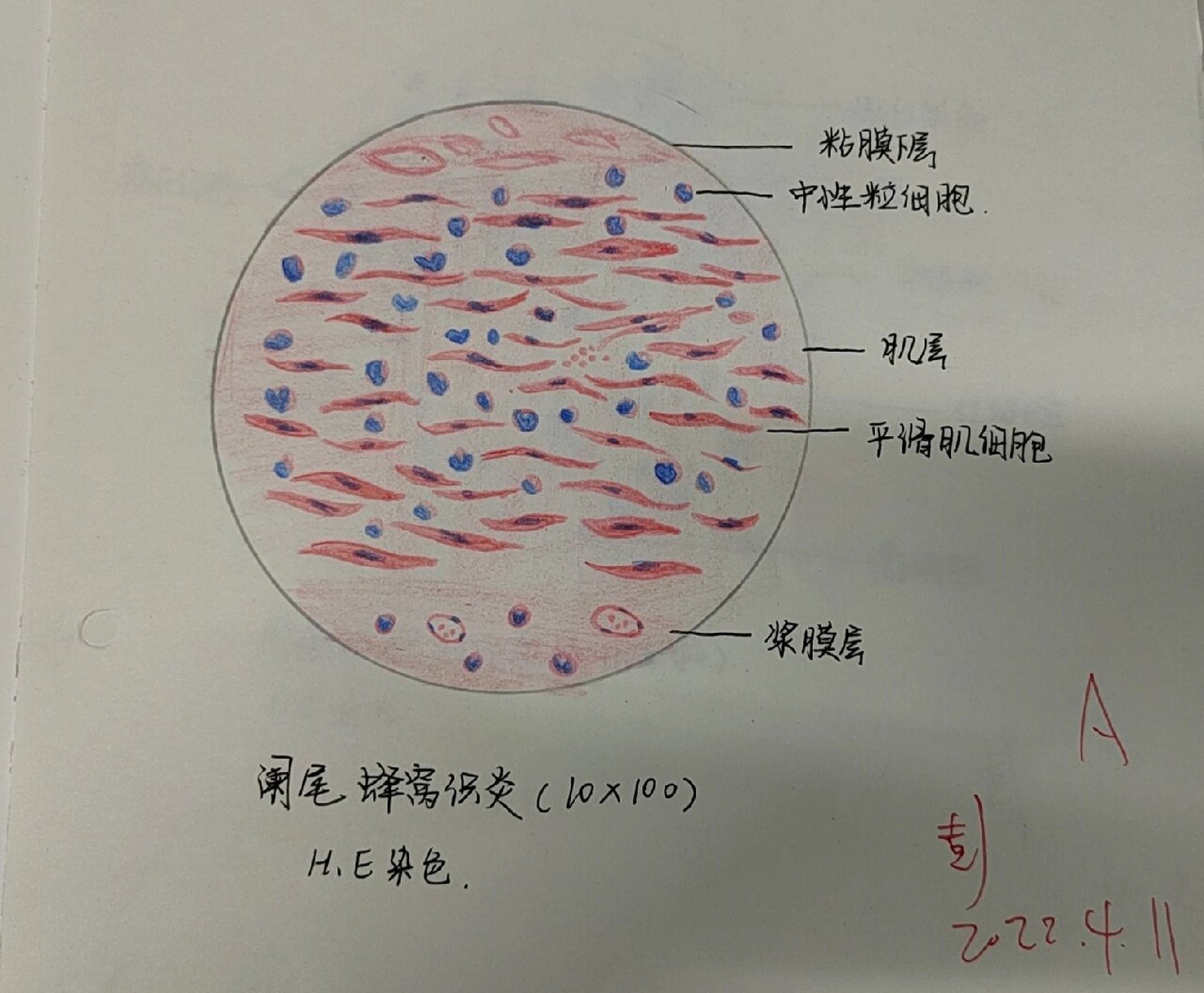 分享几张病理红蓝铅笔绘图 p1肉芽组织 p2阑尾蜂窝织炎 p3肿瘤细胞