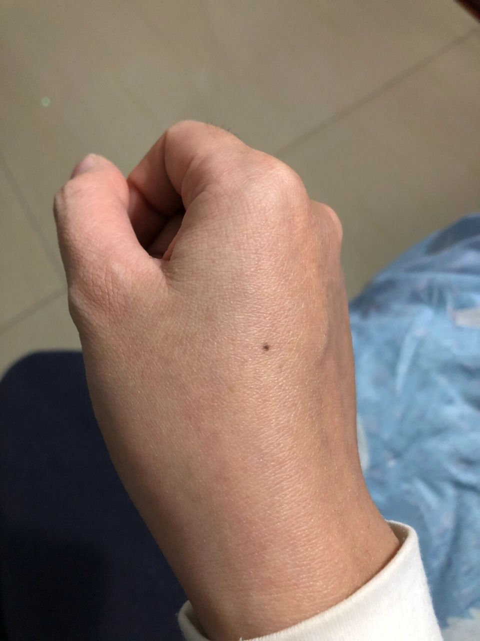 为什么人会忽然长痣 几年前手上忽然有颗小小的痣,我记得这玩意儿之前