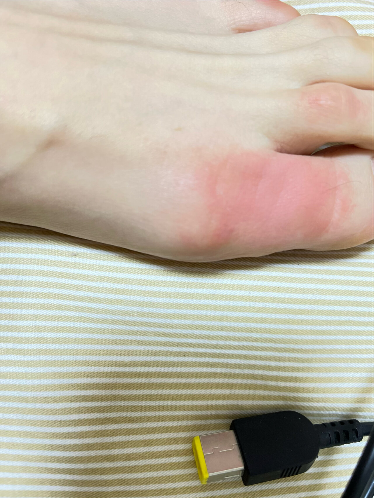 【急性荨麻疹性血管炎】住院前记录 94吃了治疗幽门螺旋杆菌的一线