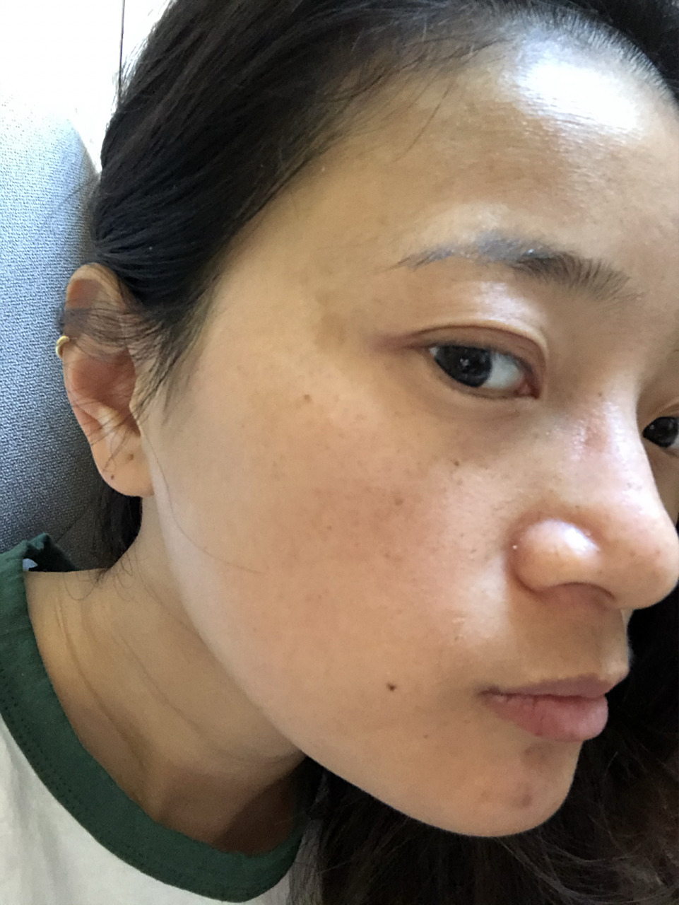 大家知道这是什么斑,该怎么预防.