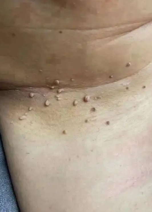 胳肢窝长了个小肉粒是什么原因?