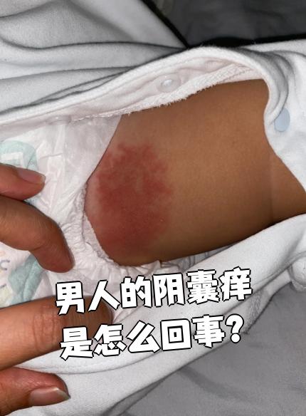 比如得了股癣