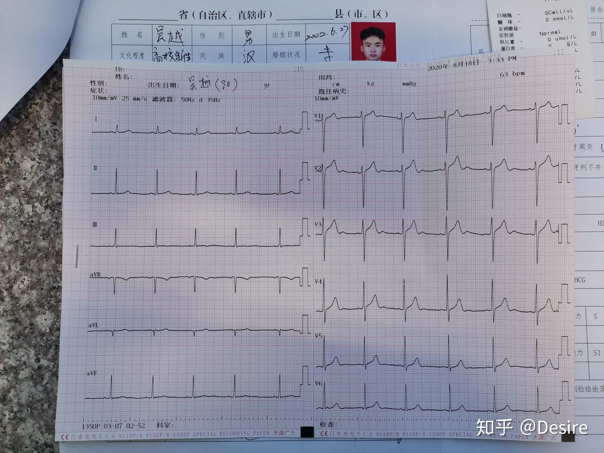 今年征兵初检不正常心电图我该如何面对复检