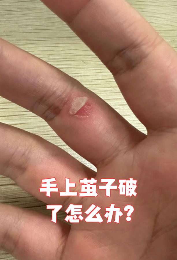 手上茧子破了(医学上叫胼胝破裂)可以这样处理: