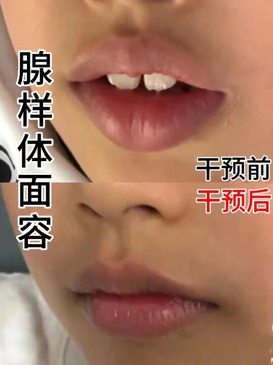 鼻炎腺样体,好在发现的早!