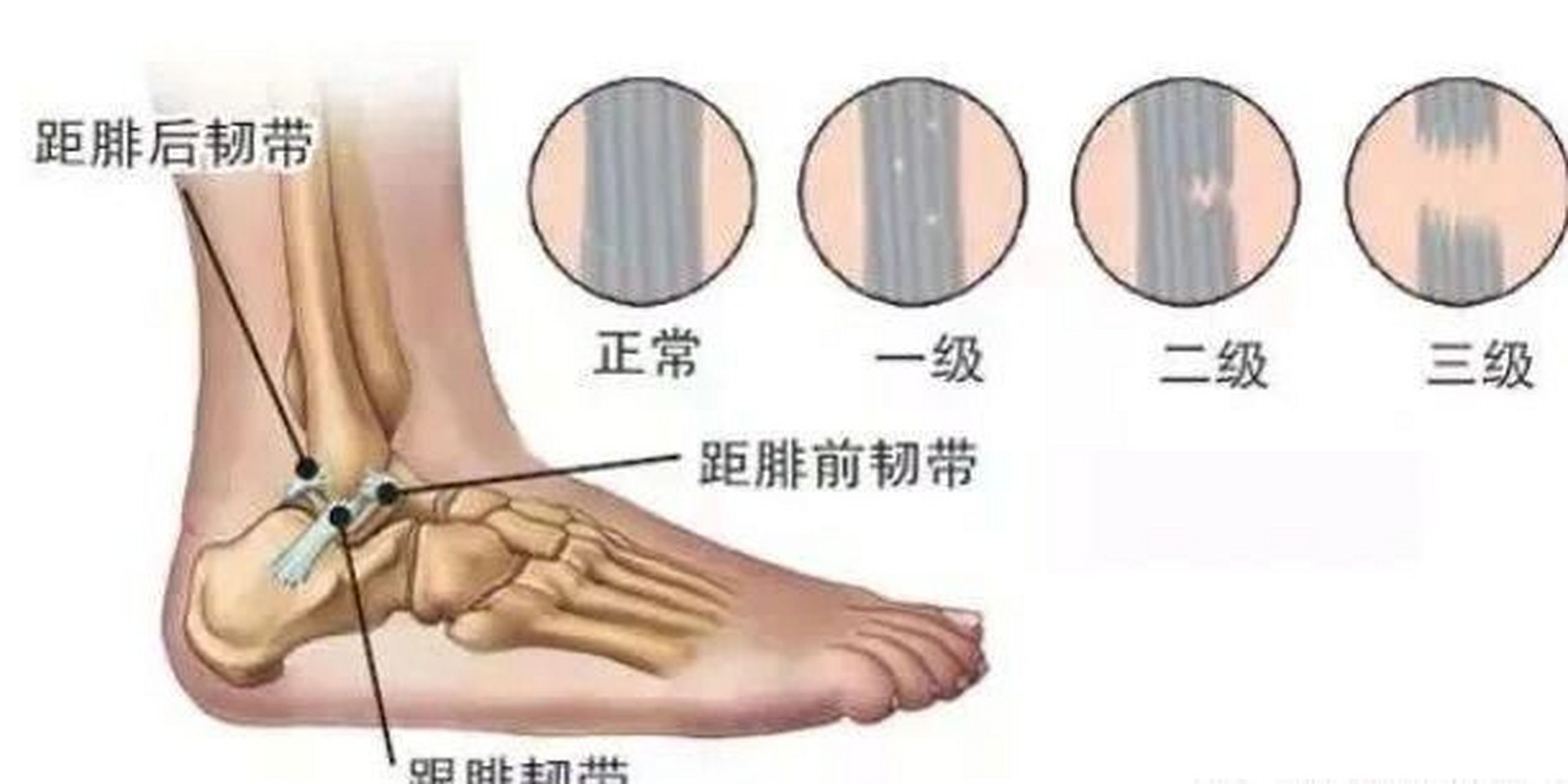 iii 级是韧带的完全断裂,引起踝关节不稳.踝关节扭伤大致分为三级!