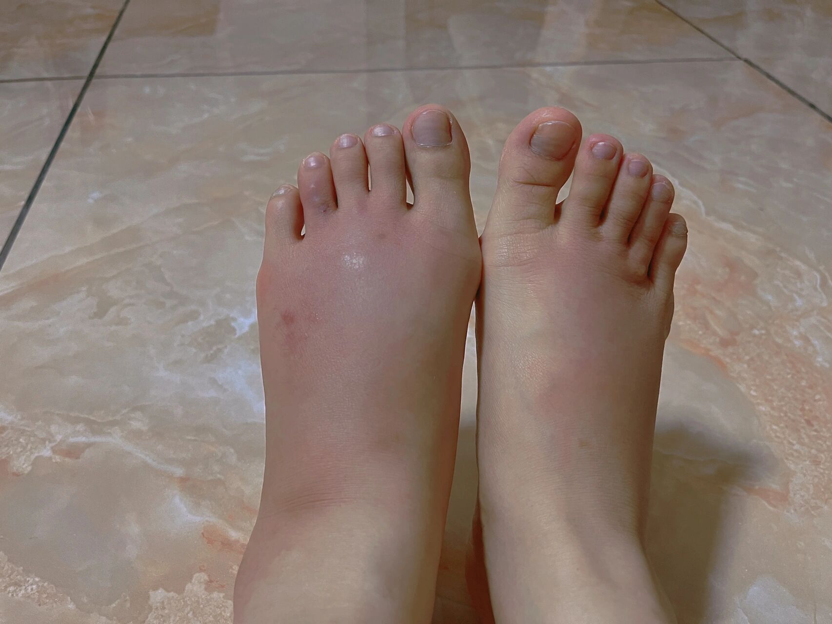 被蚂蚁92咬的红肿的双脚93 抹了四种药膏没效果 求各位大神支招