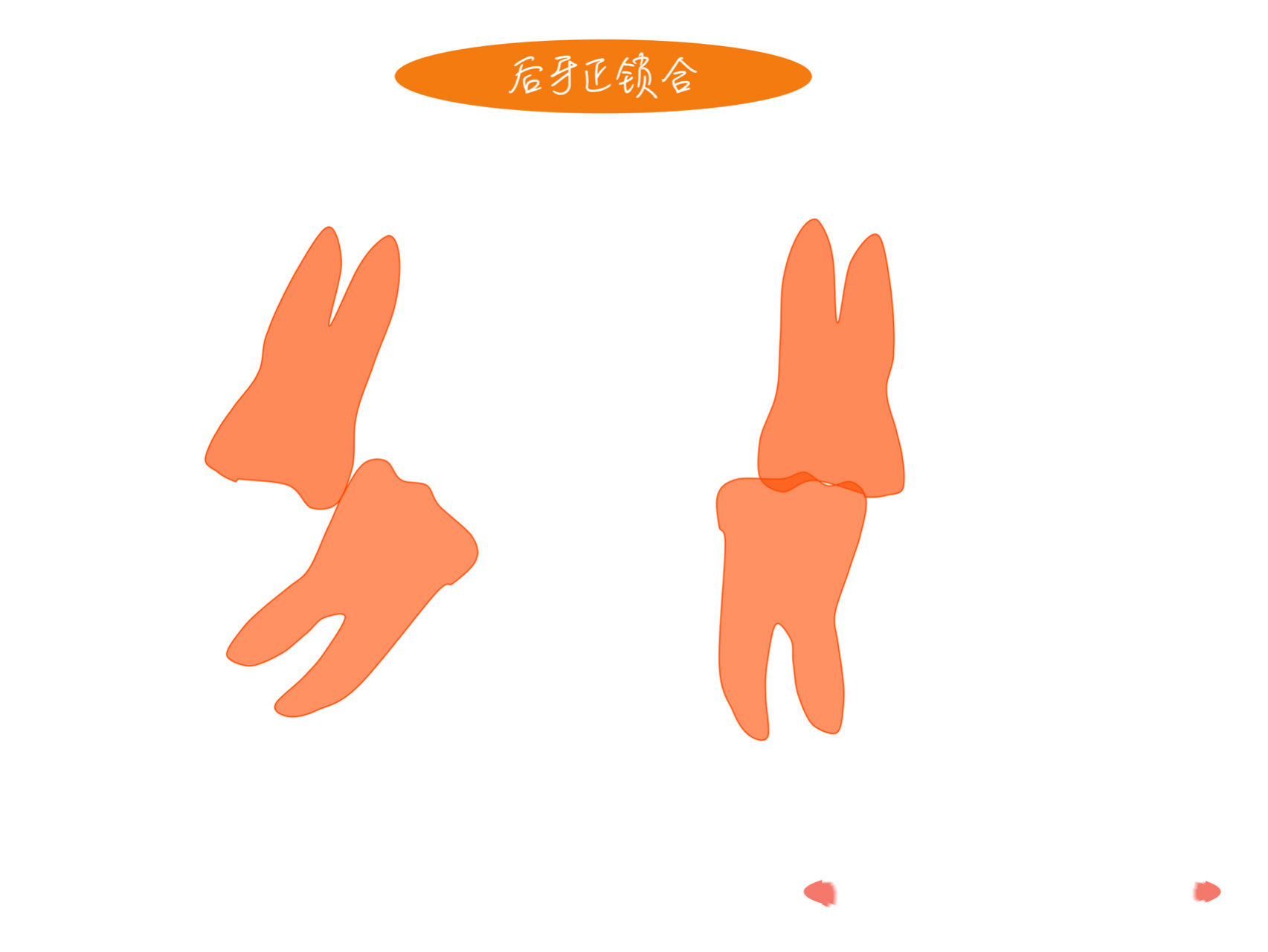 正锁颌解题策略 锁合主要是下牙弓后段狭窄造成的颊侧正锁合, 锁合