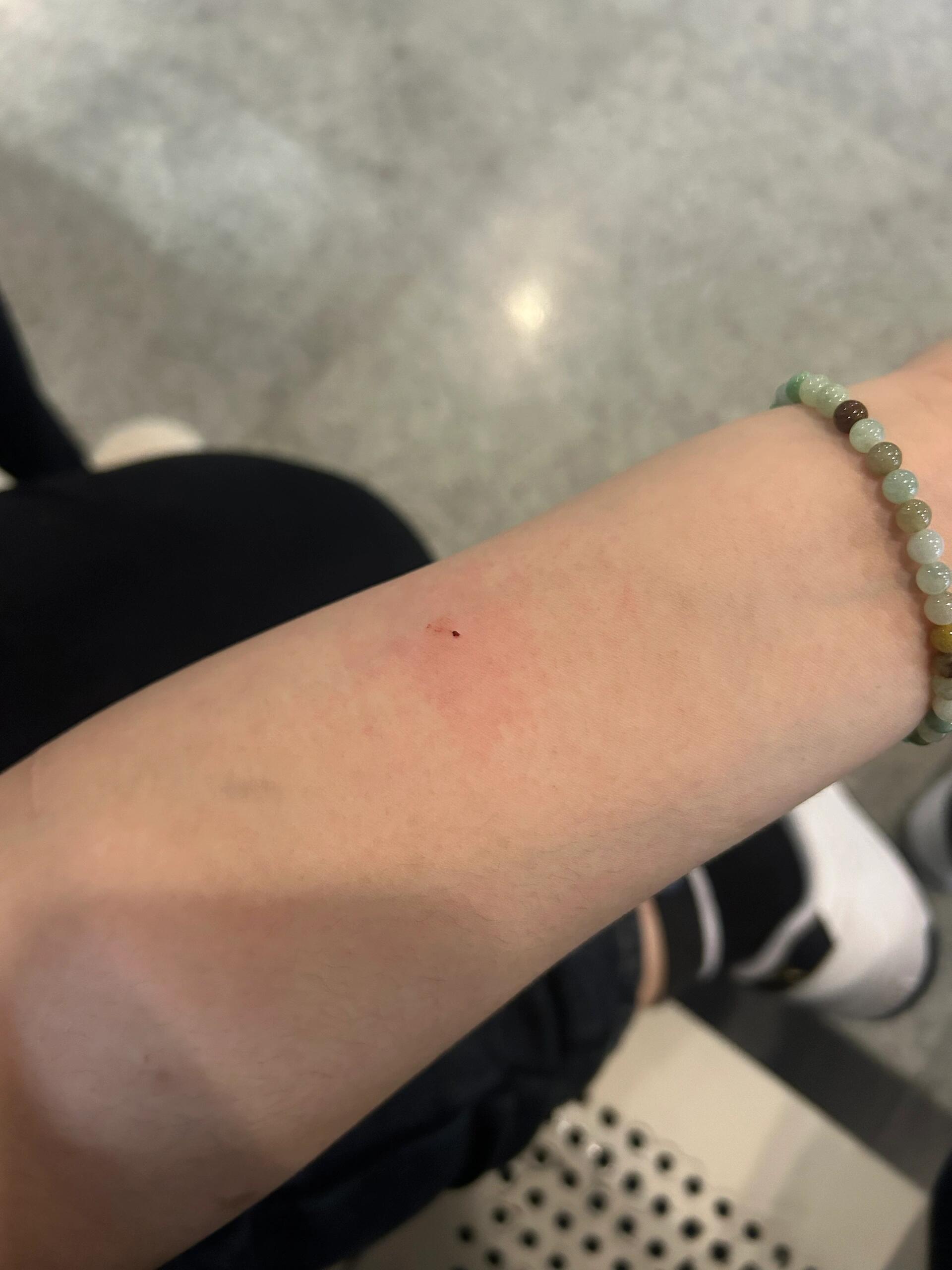 过敏这件事～ 手被刀子戳了,流血哇哇的,医生建议打破伤风,做皮试