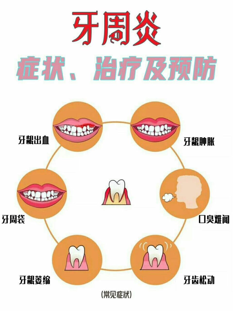 00牙周炎的症状 1,口臭难闻 2,牙龈红肿胀痛 3,牙龈刷牙经常出血 4