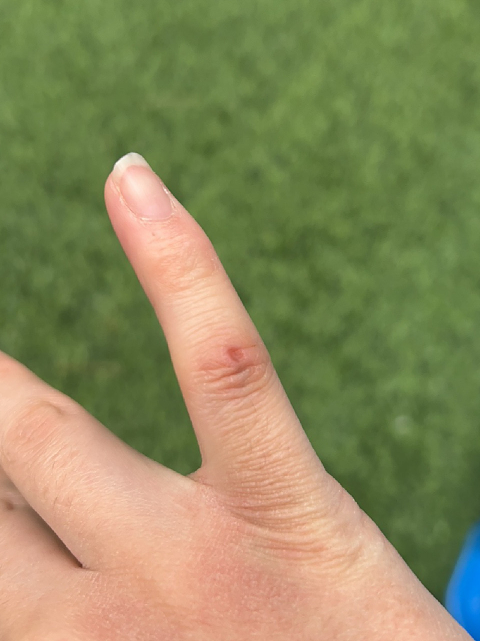 被自己家的狗牙齿划了怎么办! 已经伤口清洗过了,要打疫苗吗!