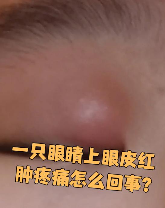一只眼睛上眼皮红肿疼痛,最常见的原因是麦粒肿,睑缘炎,眼睑脓肿或
