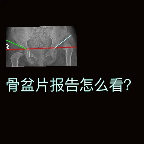 9292髋臼角:(如图一的y字形夹角)正常时,新生儿为30°,1