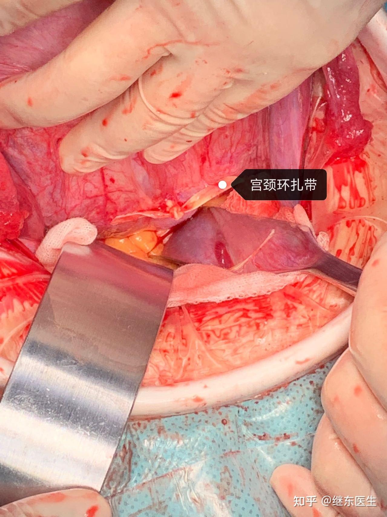 腹腔镜宫颈环扎术