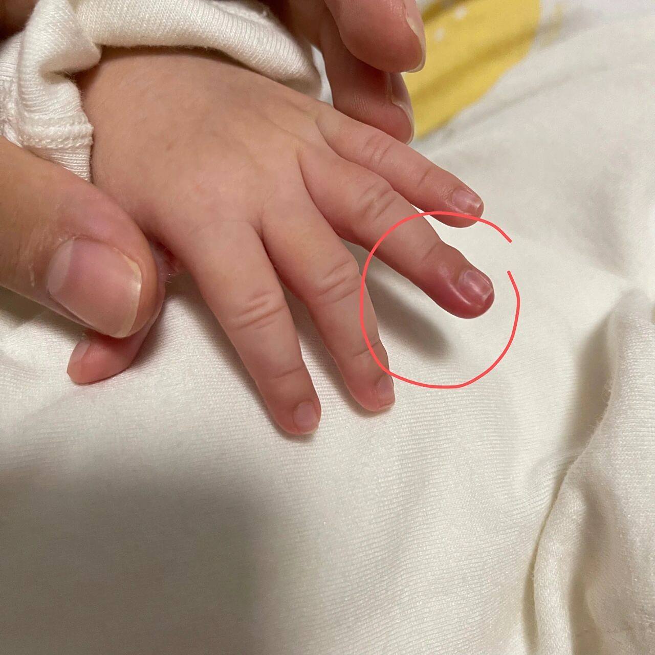 宝宝手指肿了 好像甲沟炎,怎么办?