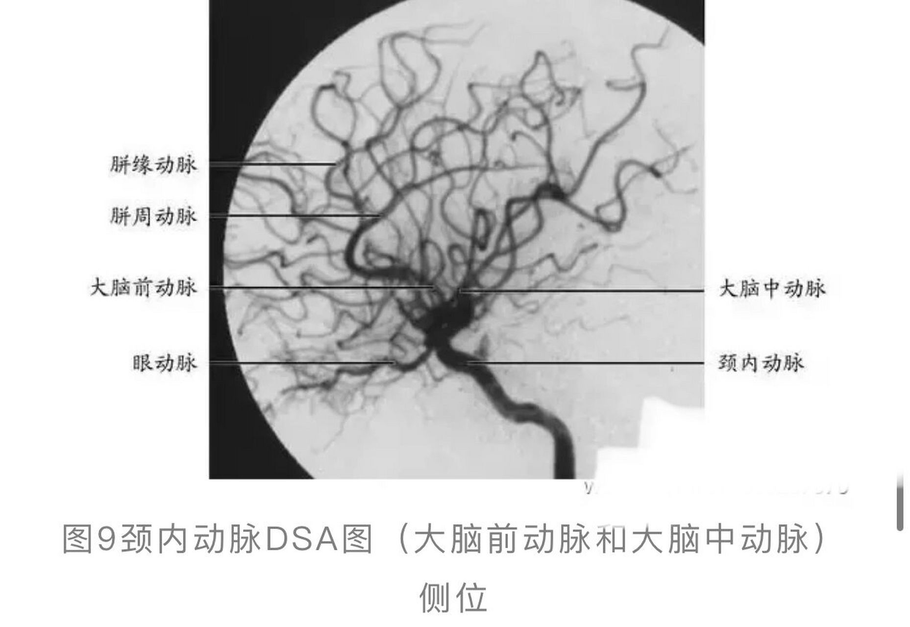 大脑动脉解剖图影像学图片