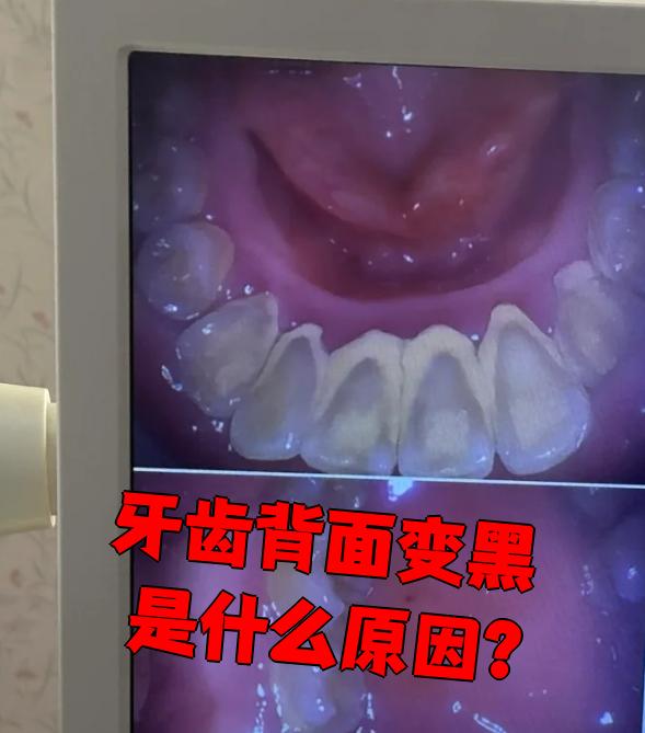 为什么蛀牙会越来越深为什么在线