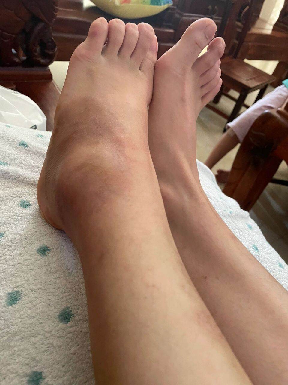 骨折日记7:自家动手拆石膏 在网上买的弹力绷带到了,刚好在医院重新