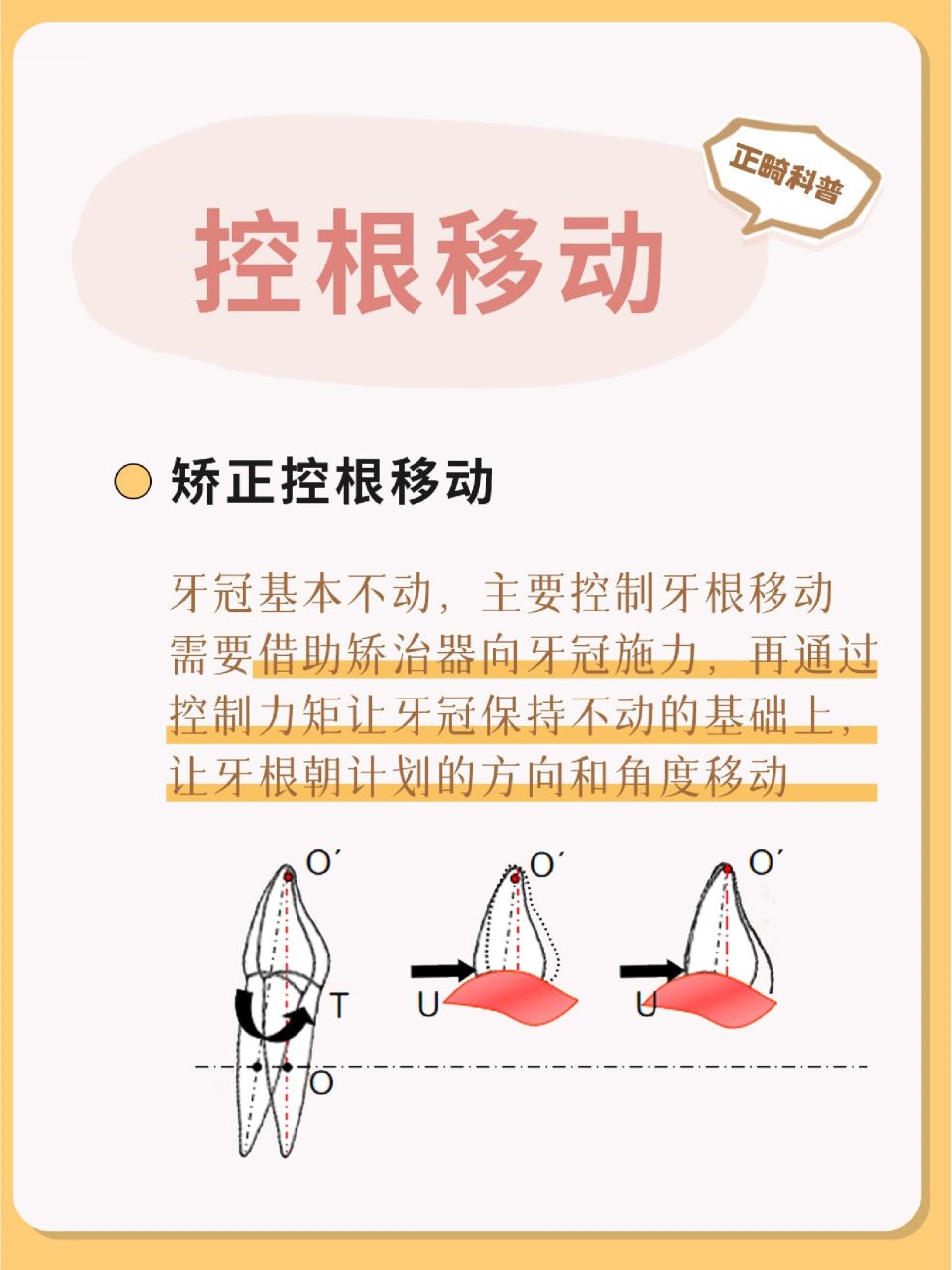 正畸科普丨牙医说我的牙需要控根内收?