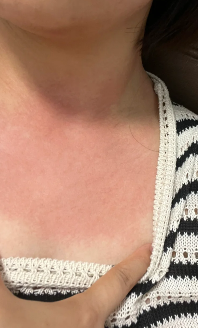 紧张或激动时脖子胸前发红,最常见的是正常生理反应,但也可能是过敏