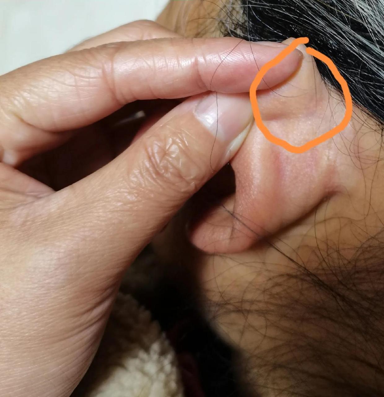 分享一个治疗牛皮癣的外治法——耳背静脉点刺放血 耳轮脚轻划外敷胡