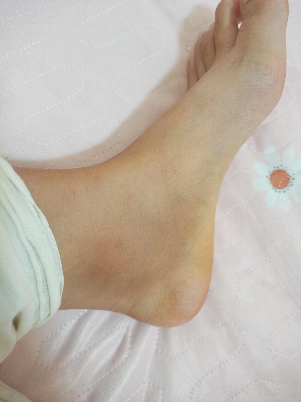 崴脚的两个月 不知道怎么弄的,第二天醒来感觉脚很涨 一看脚踝处肿了