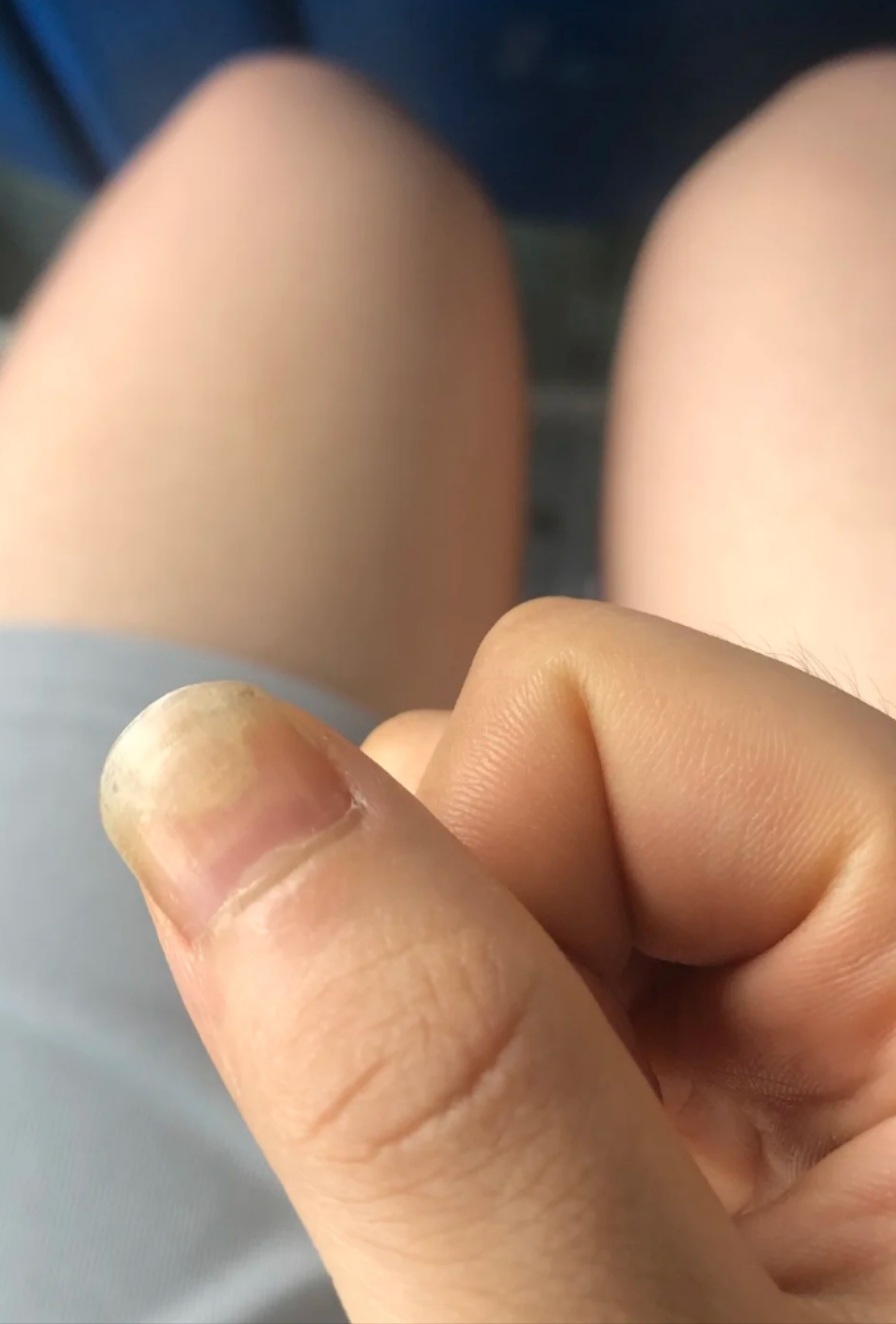 大拇指指甲和肉分离最常见的原因是外伤或真菌感染