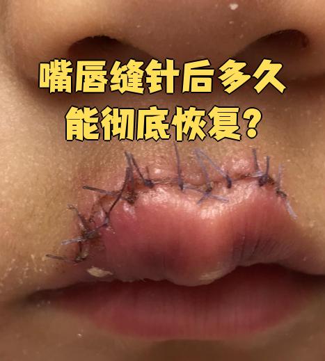 嘴唇缝针后一般7