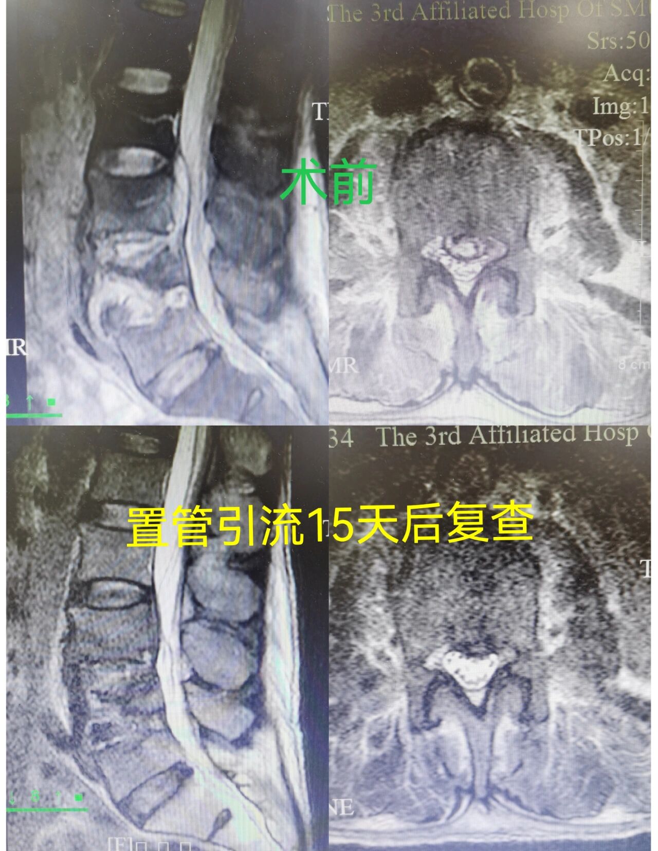 椎间隙感染,椎间孔镜辅助下减压 自制的双腔引流管引流,不堵并持续